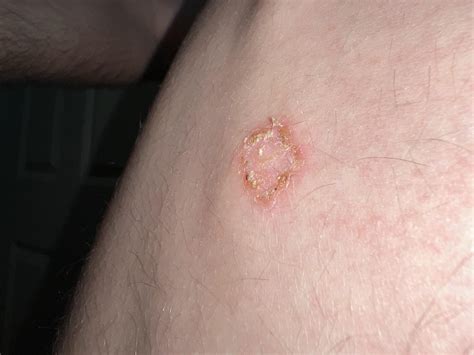 Nummular Eczema Vs Ringworm