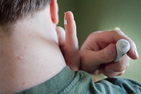 How to Treat Ingrown Hairs on the Scalp | 2bstronger.com