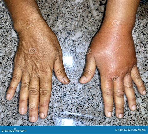 Swollen Left Foot Comparison After Wasp Sting On Female Foot Royalty ...