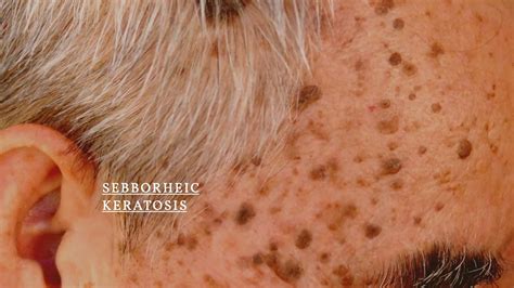 Seborrheic Keratosis Face