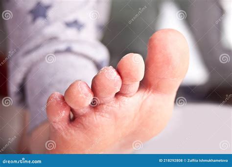 Kid Feet with Peel of Dry Skin. Closeup. Stock Photo - Image of ...