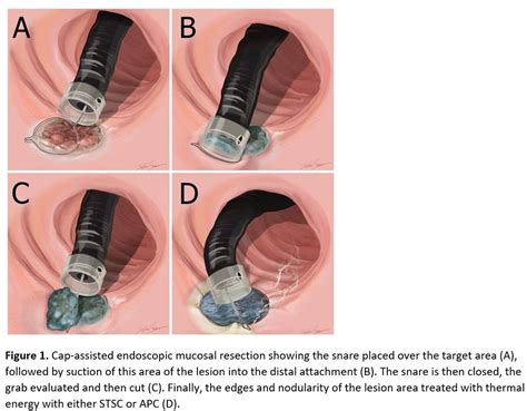 CAP-ASSISTED ENDOSCOPIC MUCOSAL RESECTION ALLOWS THE SAFE AND EFFECTIVE ...