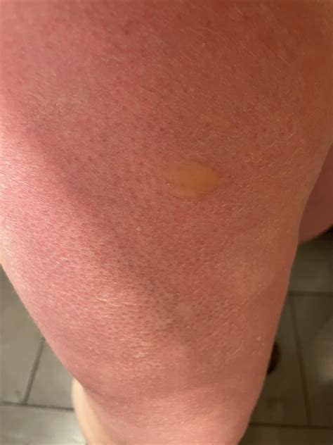 Worst sunburn I ever got : r/MedicalGore