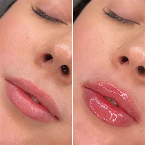 Before and after lip filler | Lip fillers, Lips, Lip augmentation