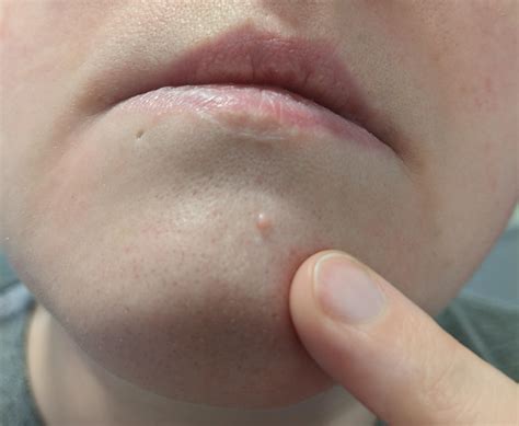 what is this hard pink bump on my chin? : r/DermatologyQuestions