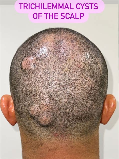 Trichilemmal Cysts - MEDizzy