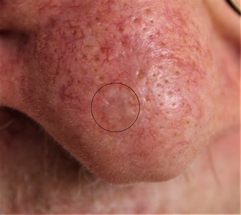 Another basal cell cancer on the nose | Dermoscopy - skin cancer on nose