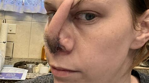 Cocaine addict has slice of her HEAD grafted onto her nose after it ...