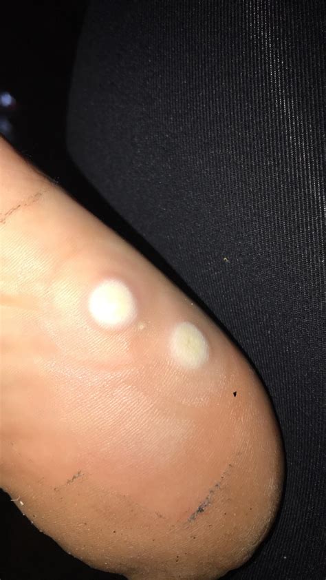 White Spots On Feet Pictures at Amy Beasley blog