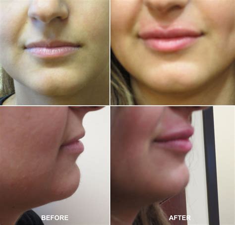 Dermal Filler Lips Injection Discount Collection | www.pinnaxis.com