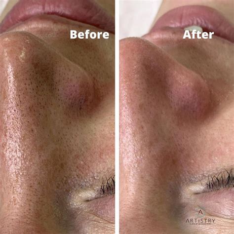 How to Get Rid of Open Pores on Face?