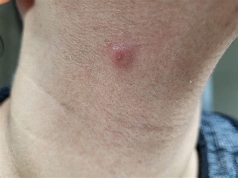 Is this a pimple or something else? Woke up this morning with this on ...