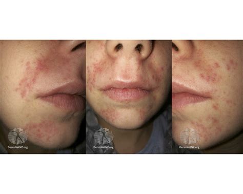 Periorbital Dermatitis