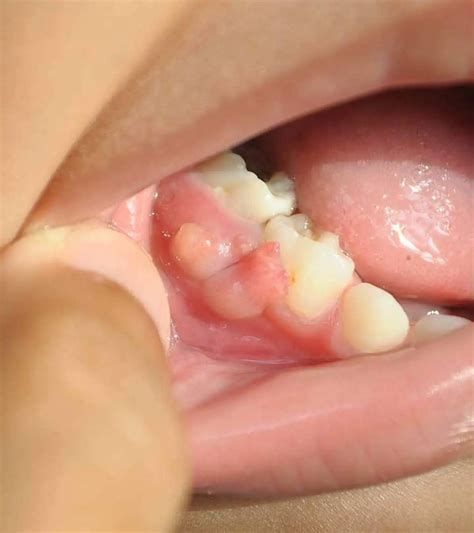 Gum Boil Remedies: 6 Effective Home Treatments For Fast Relief