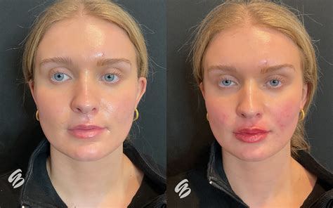 Lip Filler in Cincinnati | Amy Brenner, MD & Associates