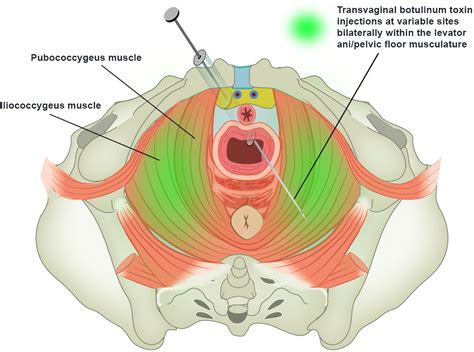 Botulinum Toxin Injections as a Treatment of Refractory Vulvodynia in ...