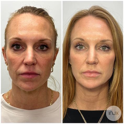 Sculptra Filler Injections: Temples, Butt Lift & More in Peoria, AZ