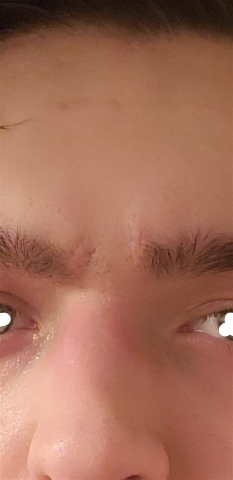 Scar Treatment Advice for Scars Between Eyebrows – Acne Scars – Acne ...