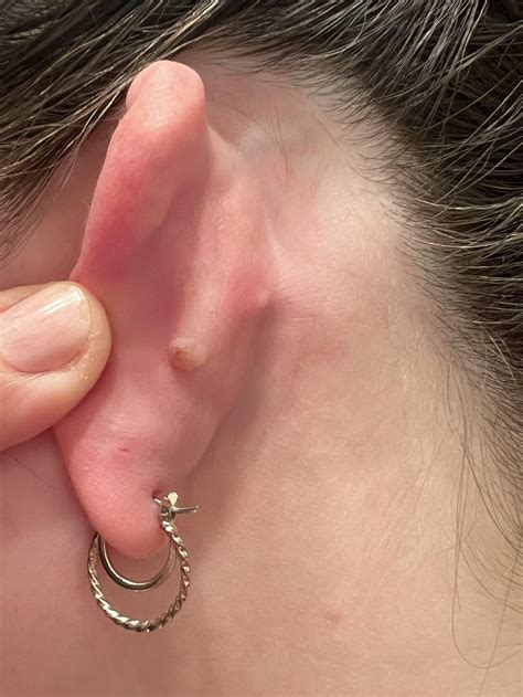 Found this lump behind my ear. Any ideas what it could be? : r/Dermatology