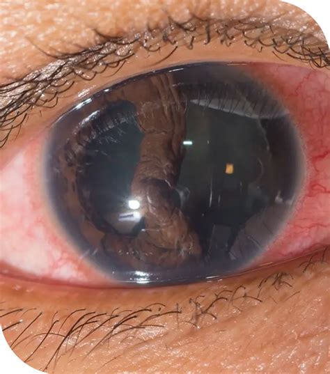 Desprendimiento de Retina | Dr. Luis Eduardo Cuenca Romo