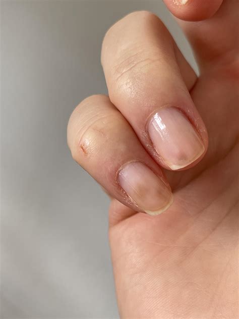 Brown Spot On Nail