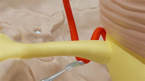 Animation microvascular decompression surgery - MedicalGraphics