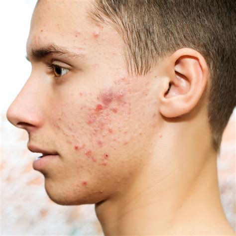 How To Treat Scars Caused By Cystic Acne - Forces of Nature Medicine