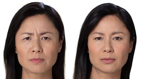5 Top Ways To Erase Forehead Lines: Laser Skin Resurfacing, BOTOX®, Skin Tightening & More ...
