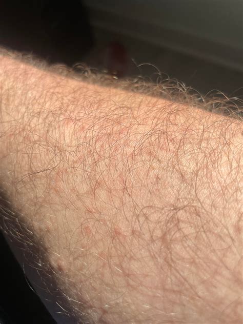 Itchy bumps on arm and forearm : r/DermatologyQuestions