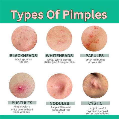 When Can You Pop a Pimple? 3 Signs You Can Pop It - Natural Skin Guides