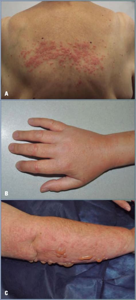 Tratamiento de dermatitis ezcema | Campus Sanofi