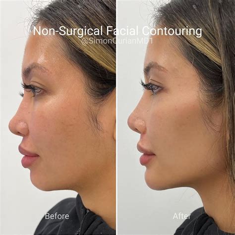 Dr. Simon Ourian - Epione | Exclusively available at Epione® Beverly Hills 😇 Treatment: Non ...