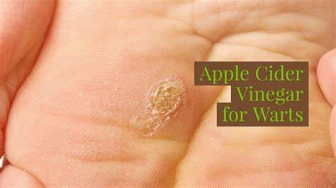 Apple Cider Vinegar For Warts Review at Samuel Moysey blog