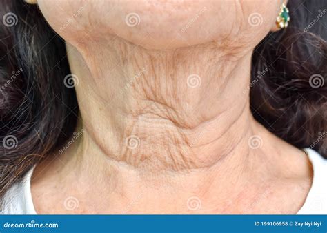 Aging Skin Folds or Skin Creases or Wrinkles at Neck of Asian, Chinese Elderly Woman Stock Photo ...