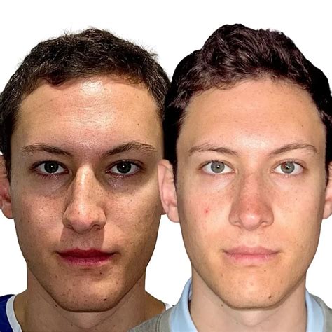 Septoplasty Before and After - Before After Journey