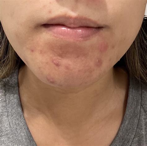 Under Skin Spots On Chin