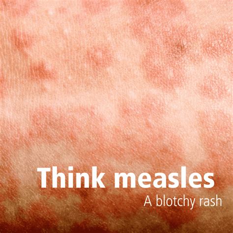 Measles Rash Vs Eczema at Dean Gillbee blog