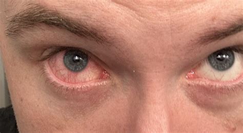 Sleeping in contacts suddenly causes red, irritated eye the next day : r/contacts