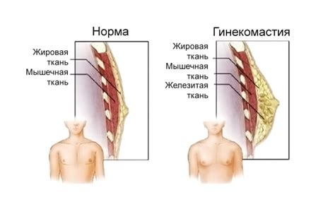 Гинекомастия - признаки, причины, симптомы, лечение и профилактика ...