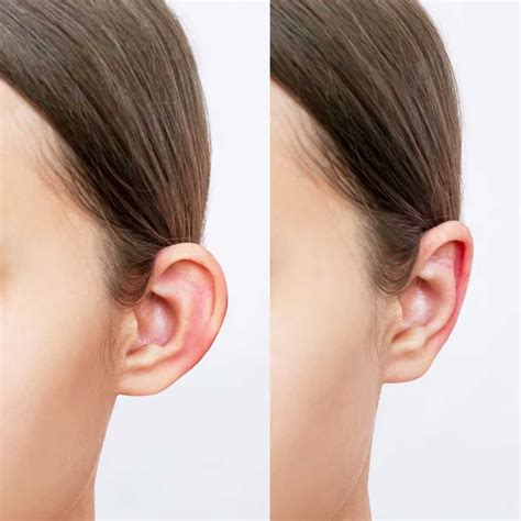 What is Otoplasty? (Ear Pinning Surgery) - Magic Touch Turkey