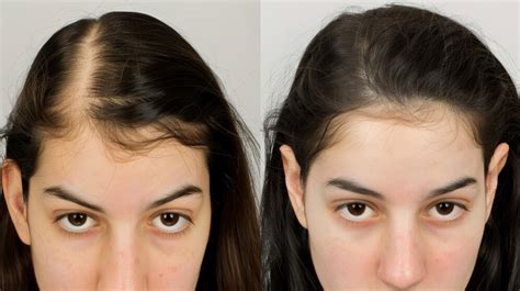Antes y después del tratamiento de crecimiento del cabello Foto de ...