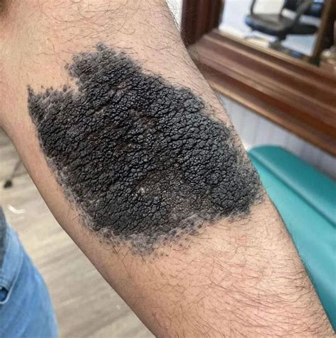 El término médico para los lunares es nevo melanocítico. Los nevos ...