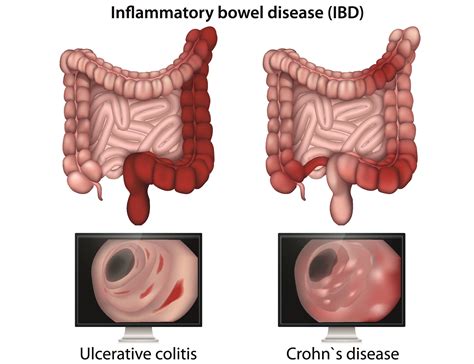 Does Diarrhea Cause Weight Loss? - Hood MWR