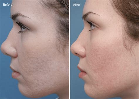 Chemical Peels for Acne Scars: Efficacy, Before and Afters, At-Home Uses