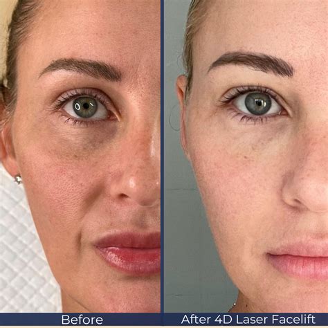 4D Laser Facelift - MONARCH MD & HAIR LAB MD