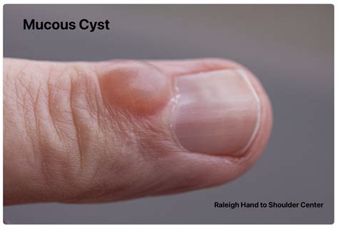 mucous cyst in finger