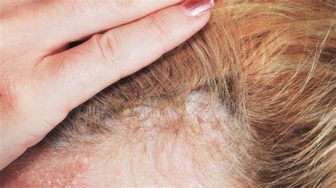 Psoriasis Scalp