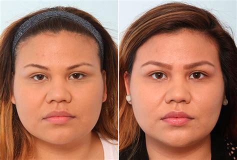Buccal Fat: Everything You Should Know About This Procedure