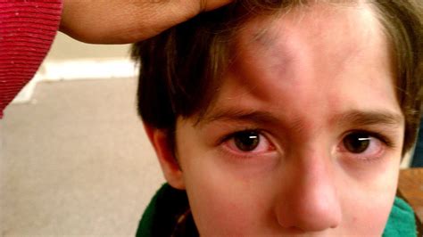 Dent In Head Injury : Head Injury In Adults - ZRYT