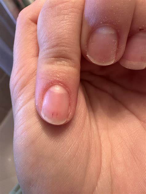 Red Lines In Fingernails at Marvin Wolbert blog